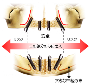 その日に噛めるインプラント『ALL-on-4』02