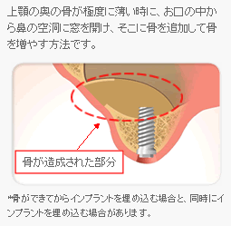 サイナスリフト法