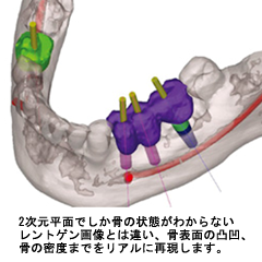 術前シミュレーション01